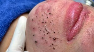 Удаление черных точек с Sac Dep Spa