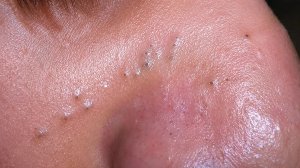 Blackhead Removal Facial Care Routine | Glass Skin Transformation