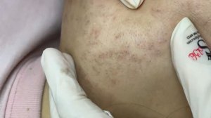 378 • Acne collection • АСМР • Relax Spa