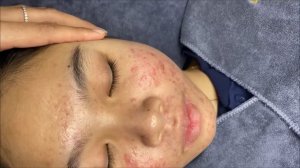 379 • Acne collection • АСМР • Relax Spa