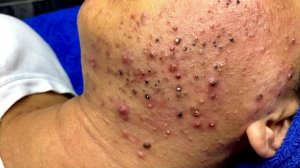 Удаление черных точек в Sac Dep Spa