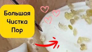 Больше часа #3. Чистка лица от угрей и акне. Выдавливание прыщей. Удаление черных точек и комедонов