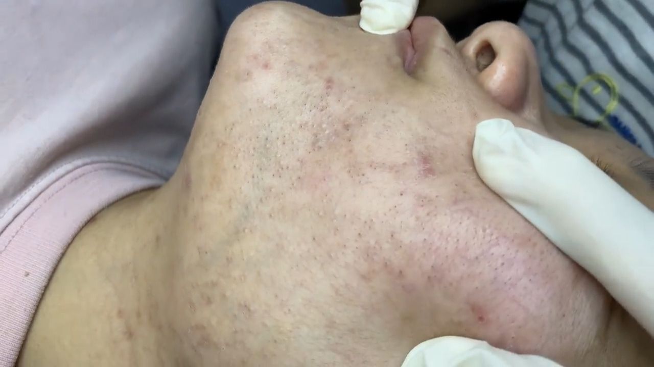 377 • Acne Collection • АСМР • Relax Spa