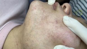377 • Acne collection • АСМР • Relax Spa