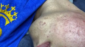 Acne collection • A037 • Архив SacDepSpa • АСМР