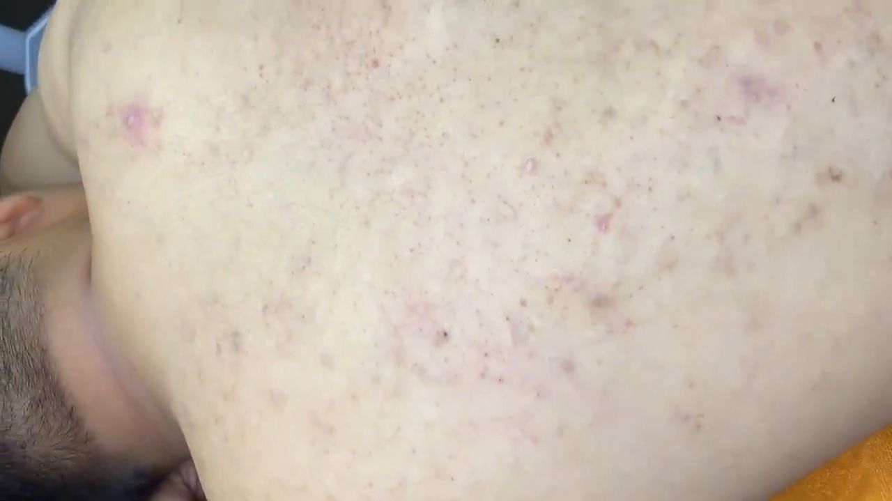 375 • Acne Collection • АСМР • Relax Spa