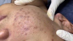 367 • Acne collection • АСМР • Relax Spa