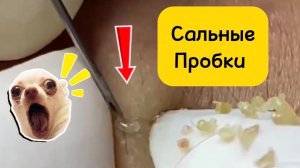 Больше часа #1. Чистка лица от угрей и акне. Выдавливание прыщей. Удаление черных точек и комедонов