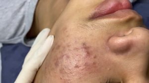 368 • Acne collection • АСМР • Relax Spa