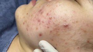 373 • Acne collection • АСМР • Relax Spa