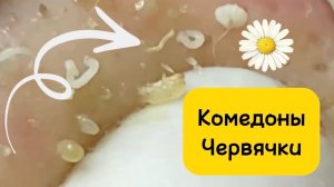 Больше часа #2. Чистка лица от угрей и акне. Выдавливание прыщей. Удаление черных точек и комедонов