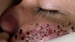 Экстремальное удаление черных точек: удовлетворение и релакс