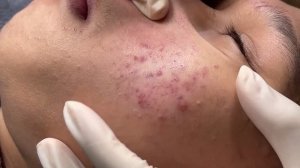Профессиональное удаление акне у косметолога