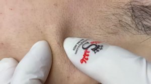 Acne collection • A036 • Архив SacDepSpa • АСМР