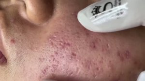 Чистка лица от множества комедонов и черных точек