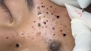 Экстремальное удаление черных точек – удовлетворение и релакс