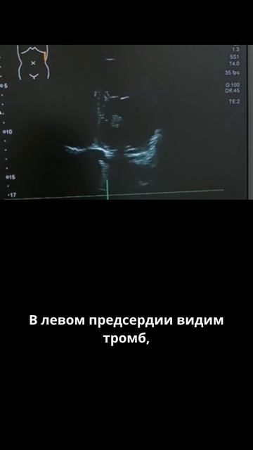 #Тромб в сердце