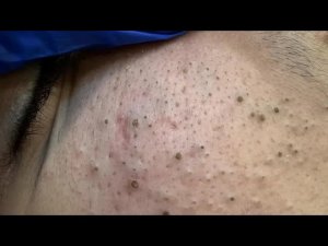 ASMR-триггеры: выдавливание черных точек и натуральные средства для чистой кожи