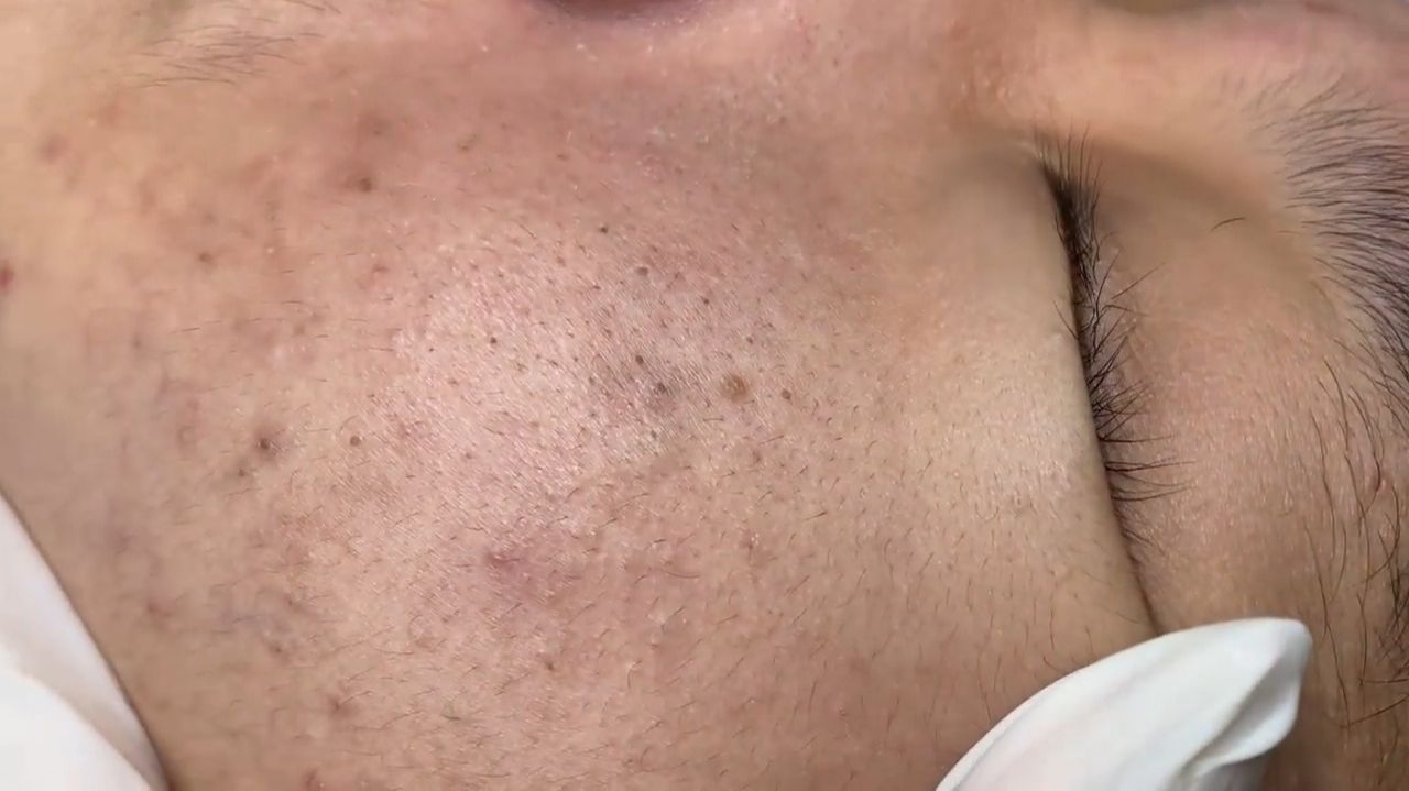 380 • Acne Collection • АСМР • Relax Spa