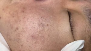 380 • Acne collection • АСМР • Relax Spa