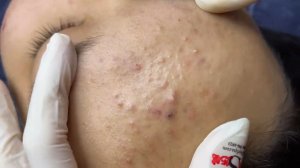 376 • Acne collection • АСМР • Relax Spa