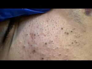 ASMR удаление черных точек и глубокое очищение | Уход за кожей для чистой кожи