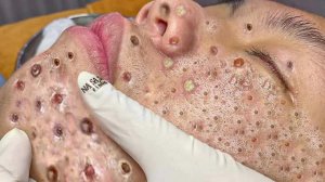 Экстремальное удаление черных точек. Удовлетворение и релакс.