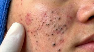 Удаление черных точек в Sac Dep Spa