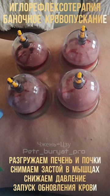 Кровопускание в ТКМ