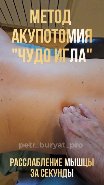 Чудо-Игла  Иглотерапия