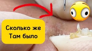 #1056 Чистка лица от угрей и акне. Выдавливание прыщей. Удаление черных точек и комедонов