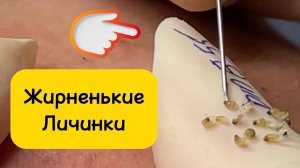 #1057 Чистка лица от угрей и акне. Выдавливание прыщей. Удаление черных точек и комедонов