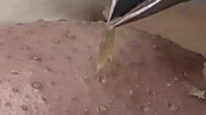 Выдавливание прыщей. Отличное качеств