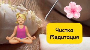 #1054 Чистка лица от угрей и акне. Выдавливание прыщей. Удаление черных точек и комедонов