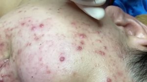 Удаление открытых комедонов и угревой сыпи