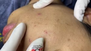 Acne collection • A038 • Архив SacDepSpa • АСМР