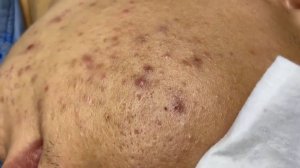 390 • Acne collection • АСМР • Relax Spa