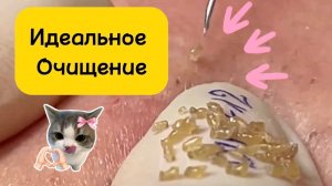 #1053 Чистка лица от угрей и акне. Выдавливание прыщей. Удаление черных точек и комедонов