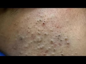 Satisfying Deep Blackhead Removal on Nose | Korean Skincare Routine