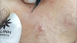 Relaxing Acne Extraction with LinhMyDang Spa #702