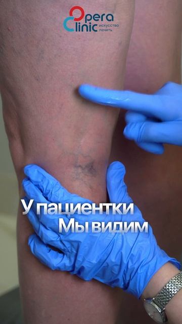 УЗИ вен перед склеротерапией
