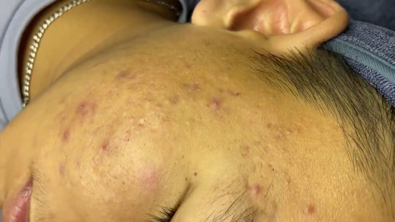 Acne Collection • A039 • Архив SacDepSpa • АСМР