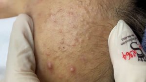 389 • Acne collection • АСМР • Relax Spa