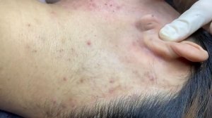 388 • Acne collection • АСМР • Relax Spa