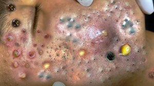 Выдавливание прыщей. Угри. Акне. чистка лица кожи