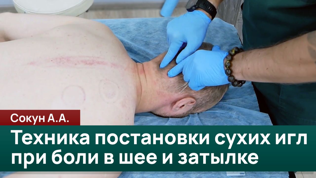Разбор техники постановки сухих игл при боли в шее и затылке. Сокун А.А.