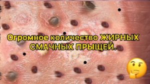 Выдавливание прыщей. НОВОЕ! Угри. Акне. чистка лица