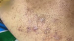 Удаление акне механическим способом – работа с проблемными зонами