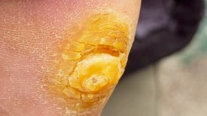 СКАЛЬПЕЛЬНАЯ ТЕХНИКА. Удаление натоптышей скальпелем.