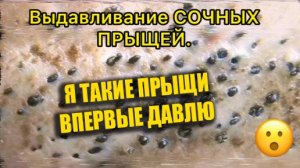 Выдавливание прыщей. Отличное качеств НОВОЕ!